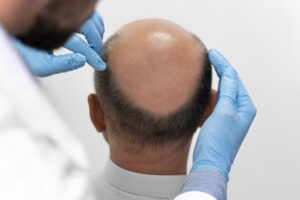 hairloss in men